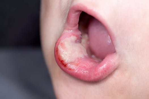 sick boy with big haze on his lips, close photo shot