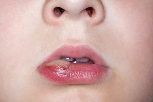 sick boy with big haze on his lips, close photo shot