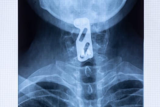 Radiography of titanium plate fixation to support the cervical spine after C5 and C6 vertebrae injury. Provide neck stability using spinal instrumentation concept.
