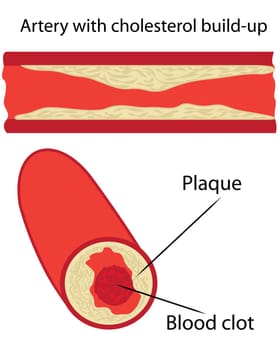 Levels of cholesterol plaque in vessels vector illustration