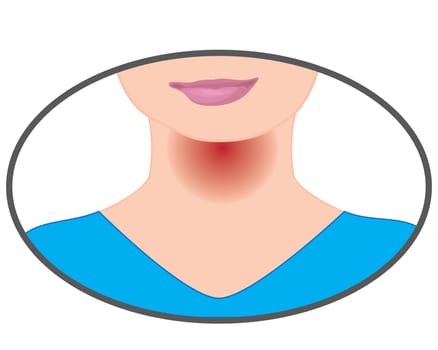 Sore throat because of flu virus influenza inspiratory infection vector illustration on a white background