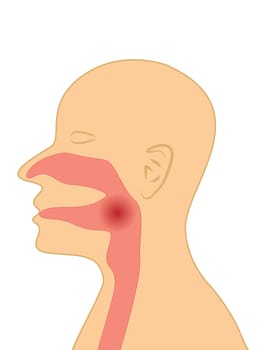 Sore throat vector illustration on a white background