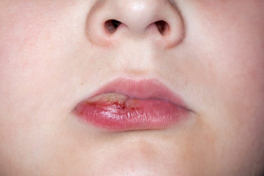 sick boy with big haze on his lips, close photo shot