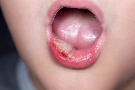 sick boy with big haze on his lips, close photo shot