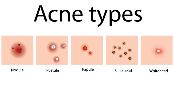 Acne types of problem skin dermatology vector illustration