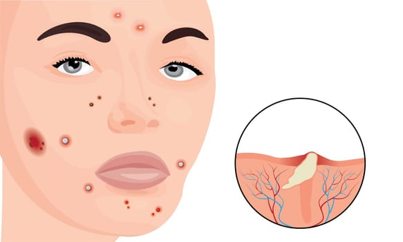 Acne on a woman face vector illustration