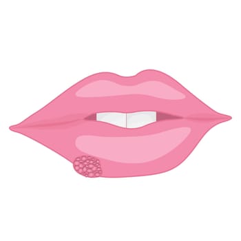 A mouth with Cold sores on lips vector illustration on a white background isolated Health care concept viral contagious infection
