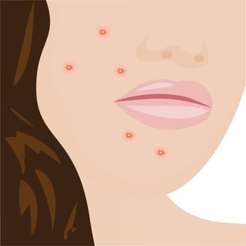 A young woman having acne infection problem skin concept vector illustration