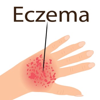 Eczema affected a hand Dermatology skin disease concept vector illustration on a white background isolated
