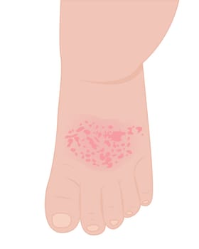 A baby foot affected with eczema vector illustration on a white background isolated