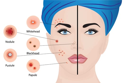 Acne types on a woman face vector illustration. Cosmetology concept, dermatology skin disease