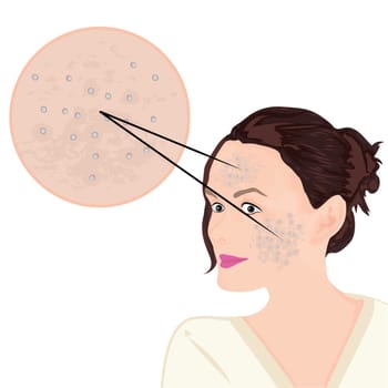 Acne on a face vector illustration showing skin problem