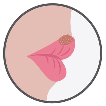 Blister on a lip of cold sores viral contagious infection vector illustration on a white background