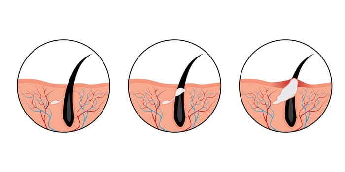 Acne pimples develop skin problem concept cosmetology vector illustration on a white background