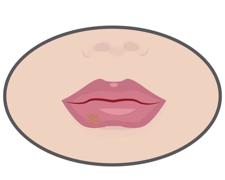 Herpes on lips cold sores viral infection vector illustration isolated on a white background