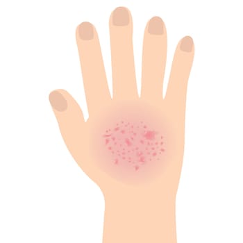 Eczema affected a hand Dermatology skin disease concept vector illustration on a white background isolated