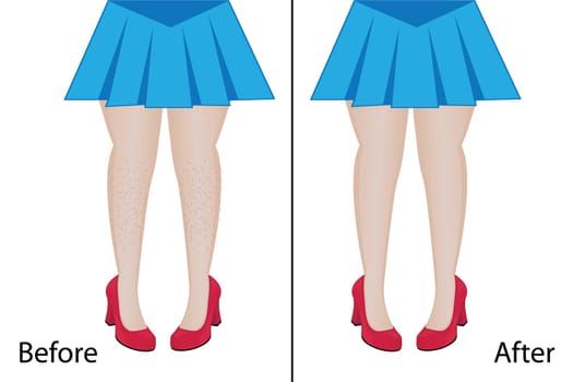 Hair removal depilation legs result before and after procedure vector illustration in cartoon style