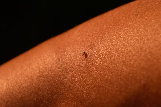 Bee sting. Bee sting in human skin. The consequences of stinging with bee venom.