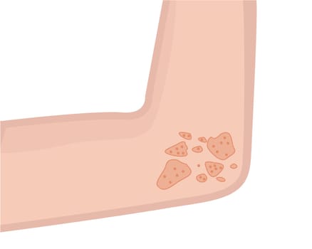 Person's elbow affected with eczema skin disease vector illustration Dermatology problem