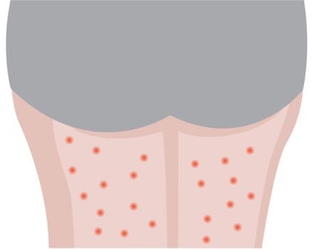 Person's legs affected with eczema skin disease vector illustration Dermatology problem