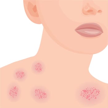 Eczema affected a body Dermatology skin disease concept vector illustration on a white background isolated