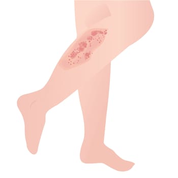 psoriasis skin disease on a white background vector illustration