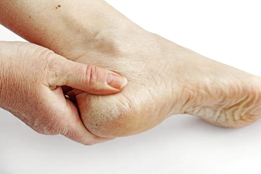 Callus and dry skin on a woman's feet. Cornea on the heel