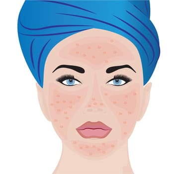 Rosacea moderate on a woman face vector illustration