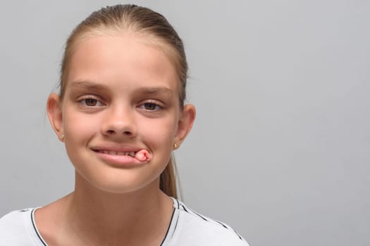 Portrait of a ten-year-old girl with a tampon that sticks out of her mouth after tooth extraction