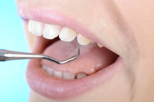 Zahnbehandlung durch Zahnarzt mit Haken
