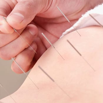 Acupuncturist applying needles on a personŽs back