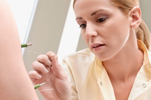 Acupuncturist applying needles and herbal cigars on a personŽs arm
