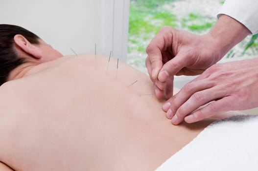Acupuncturist applying needles on a personŽs back