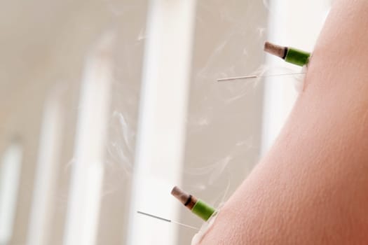 Acupuncture needles and herbal cigars on a personŽs arm