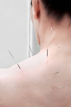 Acupuncture needles on a personŽs back