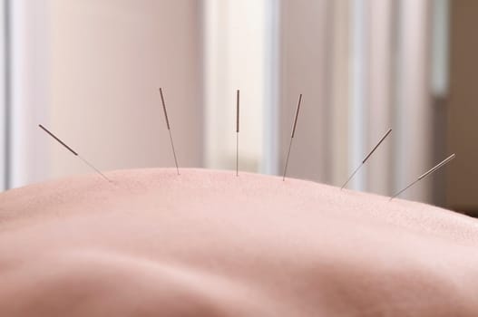 Acupuncture needles on a personŽs back