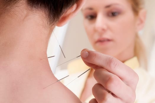 Acupuncturist applying needles on a personŽs back