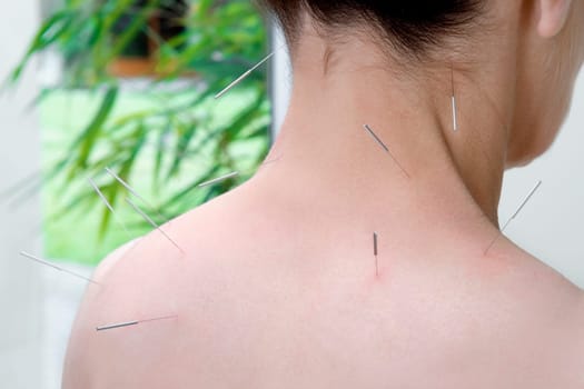 Acupuncture needles on a personŽs back