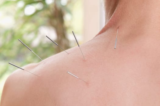 Acupuncture needles on a personŽs back