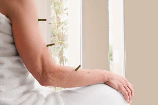 Acupuncture needles and herbal cigars on a personŽs arm