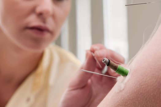Acupuncturist applying needles and herbal cigars on a personŽs arm