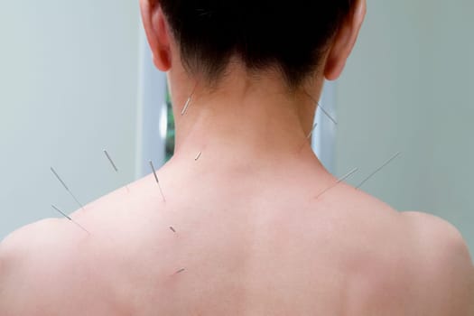Acupuncture needles on a personŽs back
