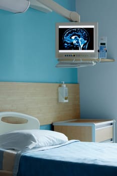 MRI scan of brain on a computer screen in a hospital ward