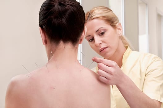 Acupuncturist applying needles on a womanŽs back