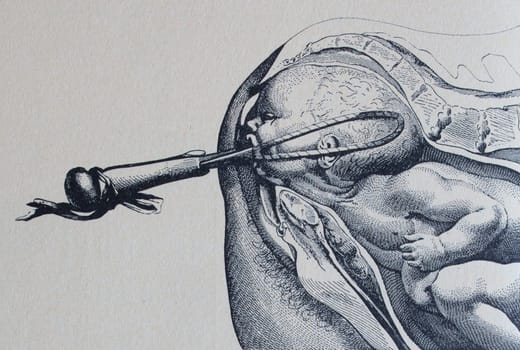 Obstetrical forceps. Depiction of improved version by William Smellie, 1754. Sett of Anatomical Tables