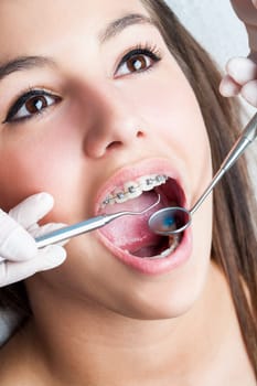 Extreme macro close up of open human mouth showing stainless steel braces.