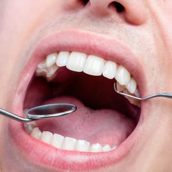 Extreme close up of Human male mouth showing teeth with dental hatchet and mouth mirror.