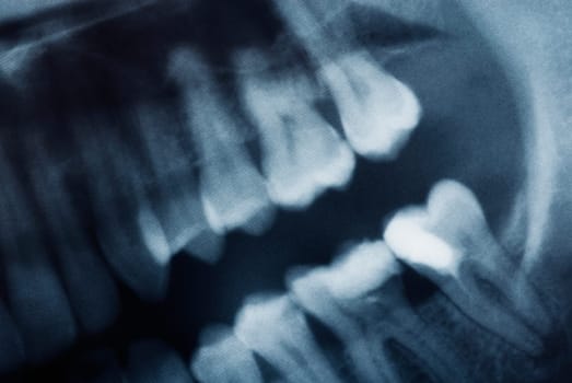 Close_up of a dental X_Ray