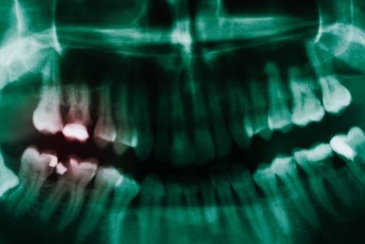 Close_up of a dental X_Ray