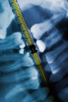 Close_up of a syringe and a dental X_Ray
